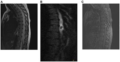 Case report and review of literature: Isolated intramedullary spinal neurocysticercosis